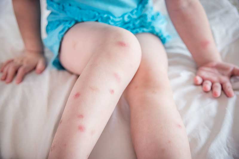 Many of mosquito bites sore and scar on little child legs who sitting on bed