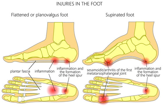 The plantar fascia is the longest ligament in your foot