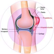 Bursitis