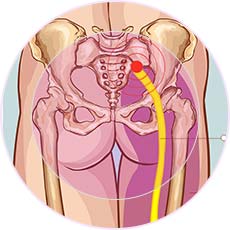 Sciatica 