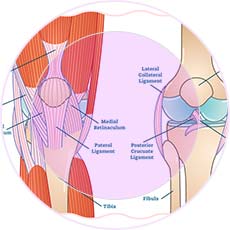 Tendonitis 