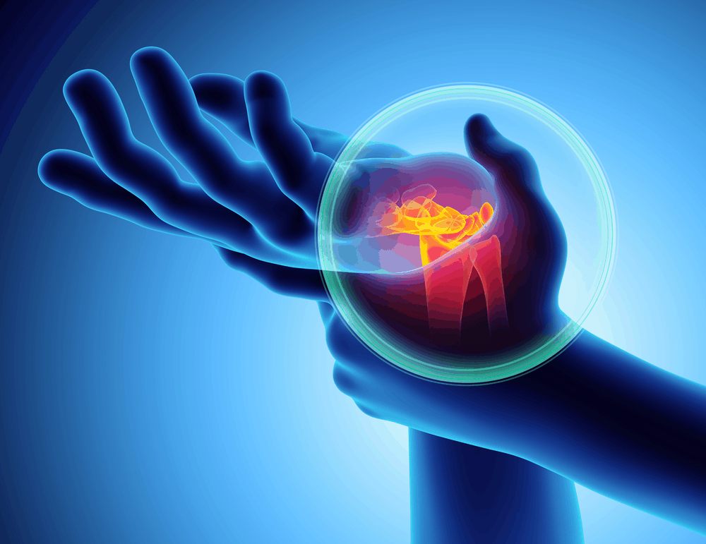 Carpal Tunnel Syndrome